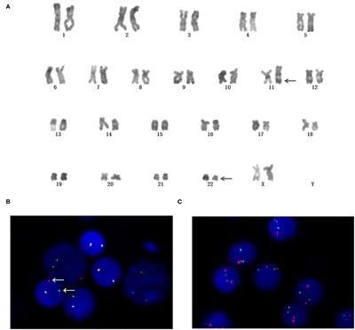 MLL-SEPT5 Fusion Transcript in Myelodysplastic Syndrome Patient With t(11;22)(q23;q11)